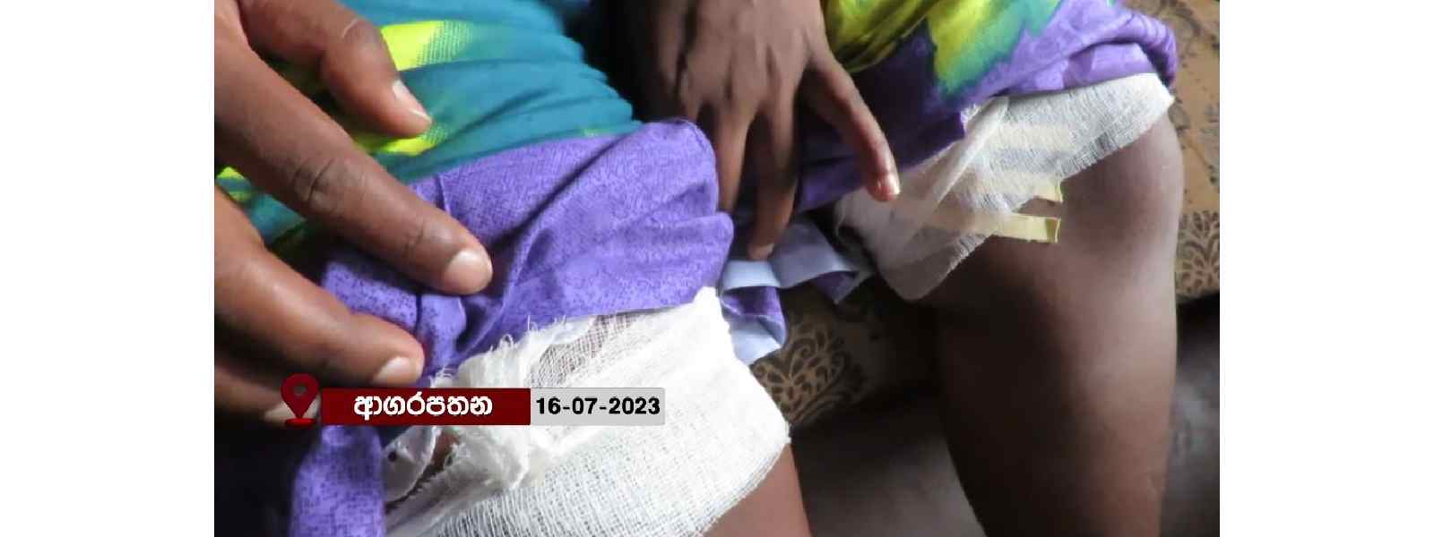 සිරුරේ අල්පෙතිනි සහිතව ආ කාන්තාව ගැන නිවේදනයක්..